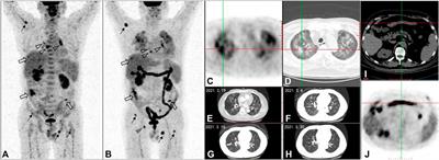 Potentials of Non-Invasive 18F-FDG PET/CT in Immunotherapy Prediction for Non–Small Cell Lung Cancer